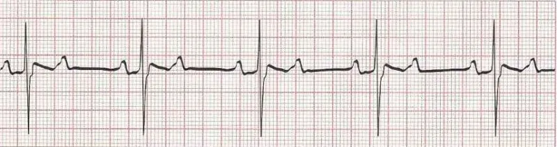 Second degree AV block type II  2:1 block