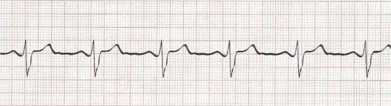 Sinus Bradycardia - 1st Degree AV Block (PR 0.22 seconds)