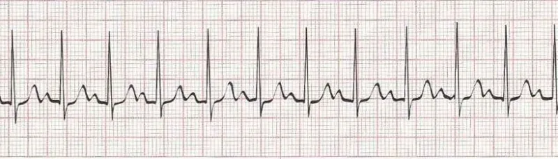 Sinus tachycardia - heart rate greater than 100