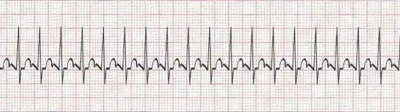 Sinus tachycardia - possibility of atrial flutter with 2:1 block
