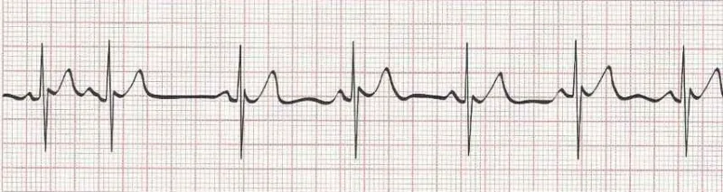 Sinus rhythm with PACs