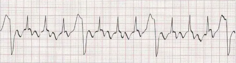 Sinus rhythm with ventricular bigeminy