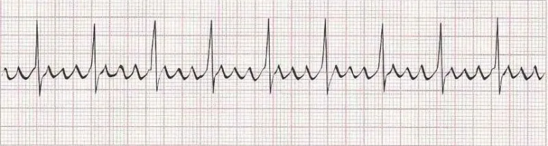 Atrial flutter with 4:1 block (sawtooth baseline)