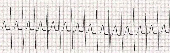 Supraventricular tachycardia (SVT)  narrow complex tachycardia