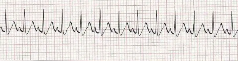 Sinus Tachycardia - heart rate greater than 100