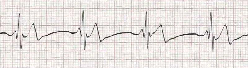Sinus bradycardia (HR 40)