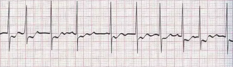Atrial Fibrillation (irregular rhythm without discernible P waves)