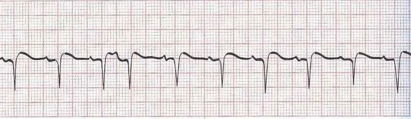 Sinus Rhythm with Premature Atrial Contractions (PACs)