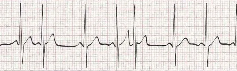 Sinus rhythm with frequent PACs