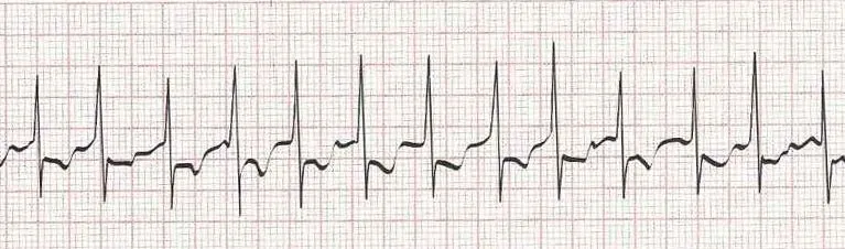Atrial fibrillation (irregular rhythm without discernible P waves)