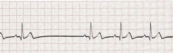 Sinus rhythm with a sinus pause