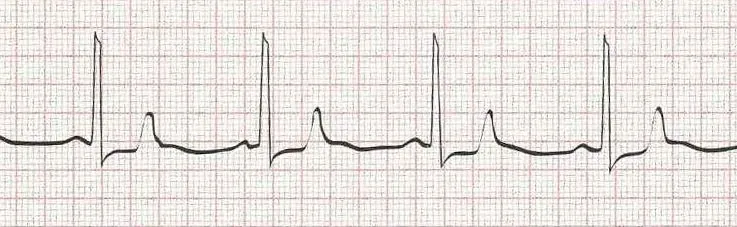 Sinus bradycardia