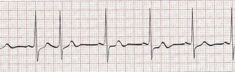 Sinus rhythm with PAC (3rd beat)
