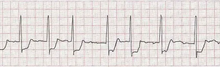 Atrial fibrillation (irregular rhythm without discernible P waves)