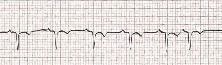 Sinus rhythm with premature atrial contraction