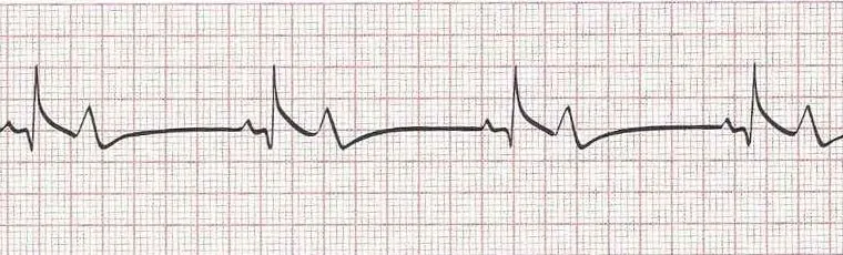 Brady with elevation