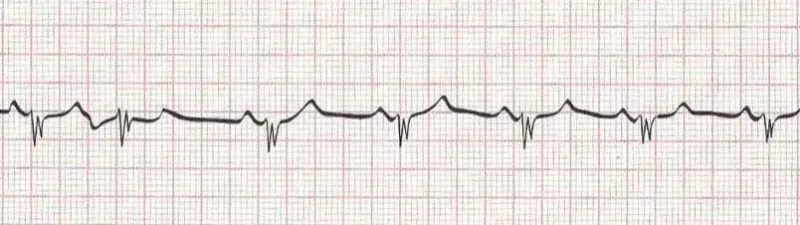 Sinus rhythm with PAC  (2nd beat)