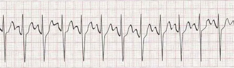 Sinus tachycardia