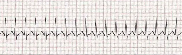 Supraventricular tachycardia (SVT)  narrow complex tachycardia