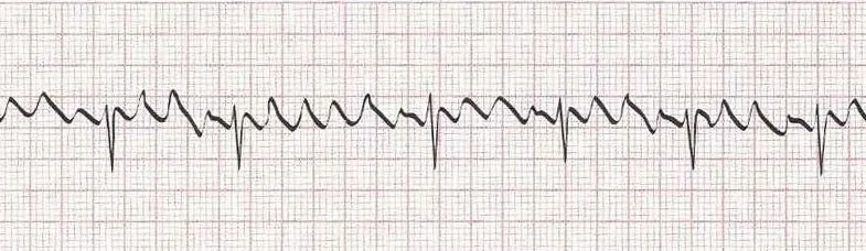Atrial flutter with variable block