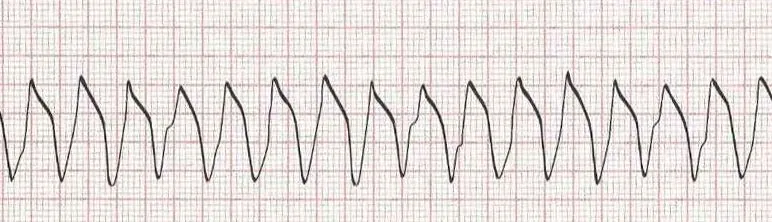 Ventricular tachycardia