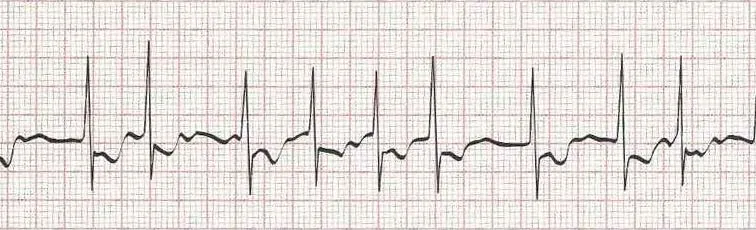 Atrial fibrillation
