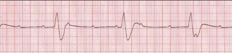 Complete heart block (3rd degree) with ventricular (wide) response