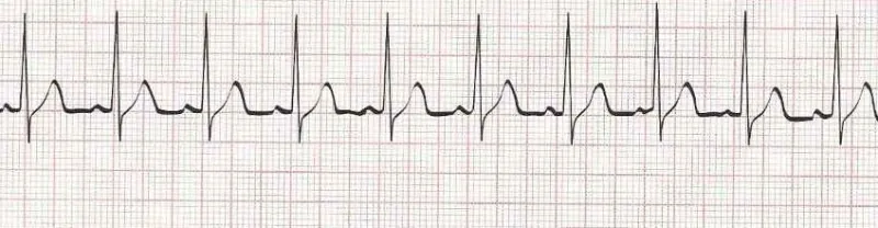 Wandering atrial pacemaker (p waves look different)