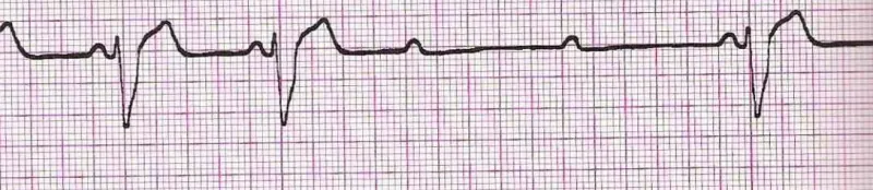 Second degree AV block mobitz type II