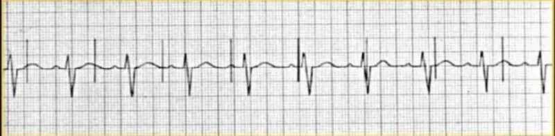 Sinus rhythm with 1st degree AV block and a pacer with failure to sense
