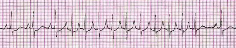 Sinus rhythm with a run of PAT (would accept run of SVT)