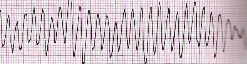Ventricular tachycardia (polymorphic VT or torsades de pointes)