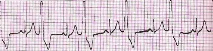 Sinus rhythm with ventricular bigeminy (PVC every other beat)