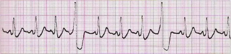 Sinus rhythm with vetricular quadrigeminy (PVC every 4th beat)