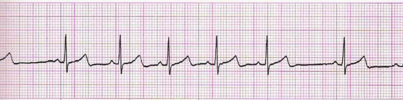 Sinus arrhythmia