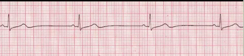 Sinus bradycardia