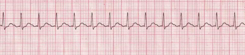 Sinus tachycardia with 1st degree AV block (0.24 seconds PR)