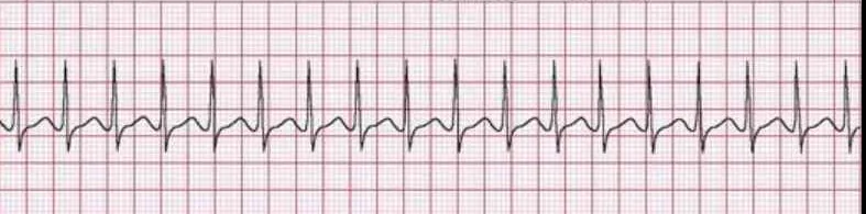 Supraventricular tachycardia (SVT)  narrow complex tachycardia