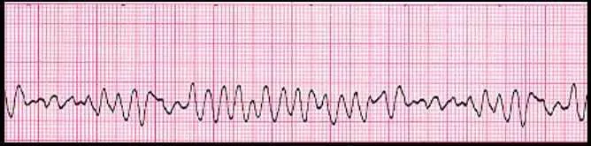 Ventricular fibrillation