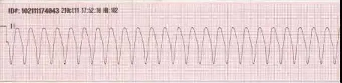 Ventricular tachycardia