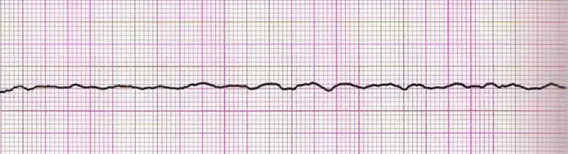 Asystole