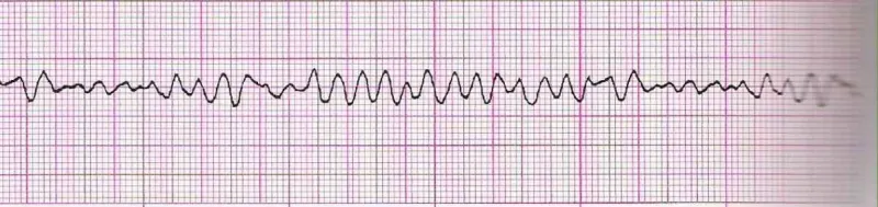 Ventricular fibrillation