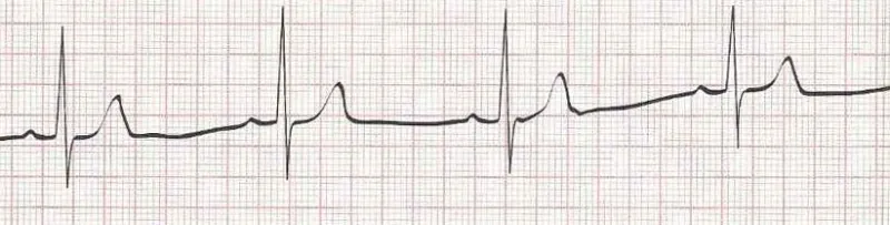 Sinus Brady - heart rate is less than 60