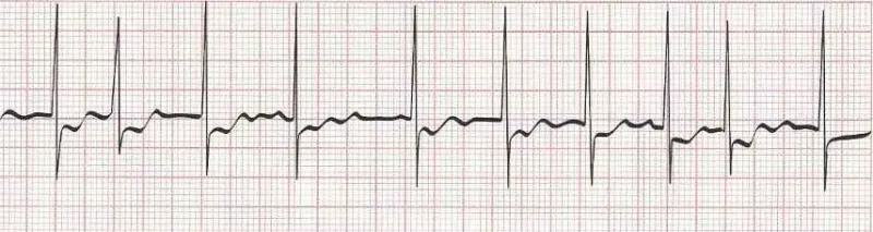 Atrial Fibrillation (rate 100):  Irregular without discernible P waves