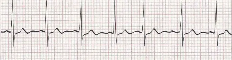 Sinus Arrhythmia (rhythm slightly irregular)