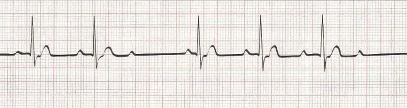 Second Degree AV Block (Second degree heart block) Type I (Wenckebach) PR longer, longer, dropped beat
