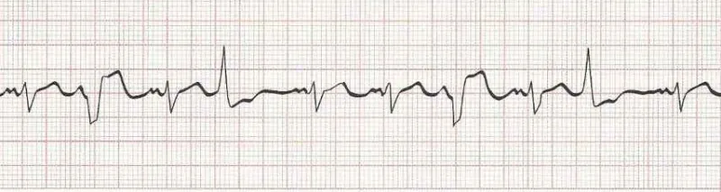 Sinus Rhythm with multifocal PVCs  (PVCs look different from each other)