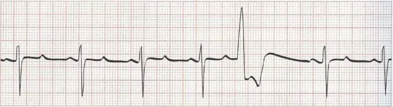 Sinus Rhythm with a PVC (Premature wide complex beat)