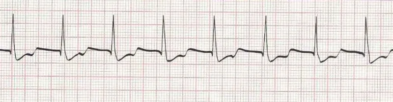 Accelerated Junctional Rhythm (heart rate is 80)