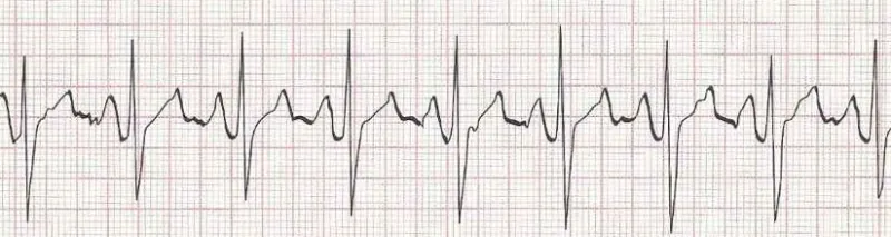 Normal Sinus Rhythm